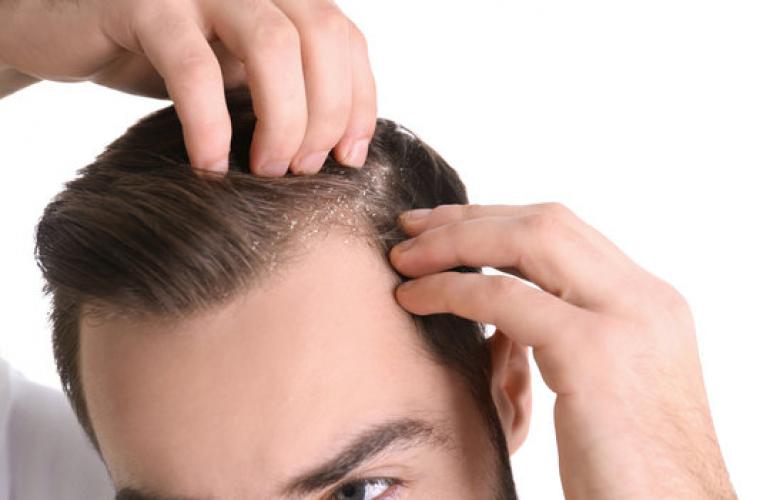 Common Mistakes That Worsen Hair Dandruff And How To Avoid Them